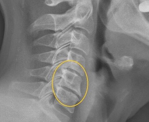 Bizkarrezurreko bizkarrezurraren osteokondrosia x -Ray batean