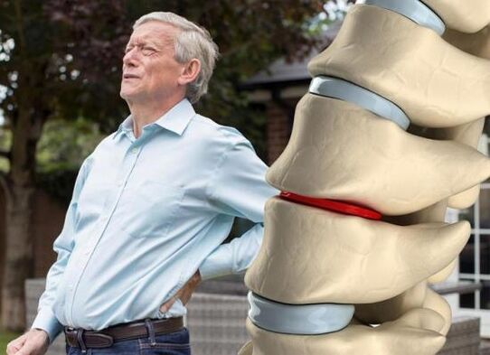 Osteocondrosis orno arteko diskoei eragiten die eta bizkarreko mina eragiten du