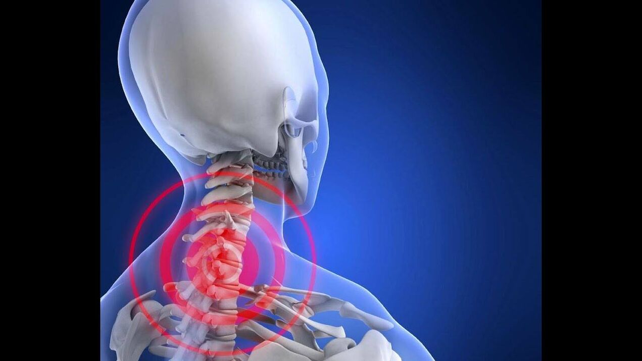 Trápaga bizkarrezurra osteokondrosia
